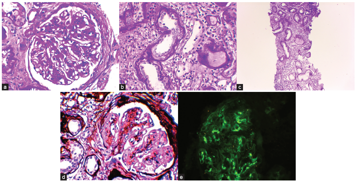 (a) Light microscopy (100X): Mesangial expansion and hypercellularity. (b) Light microscopy (100X): Tubular basement membrane thickening. (c) Light microscopy (40X): Tubular basement membrane thickening and interstitial inflammation. (d) Light microscopy (Methenamine silver stain, 100X): Mesangial expansion and hypercellularity. (e) Immunofluorescence: Mesangial IgA deposits.