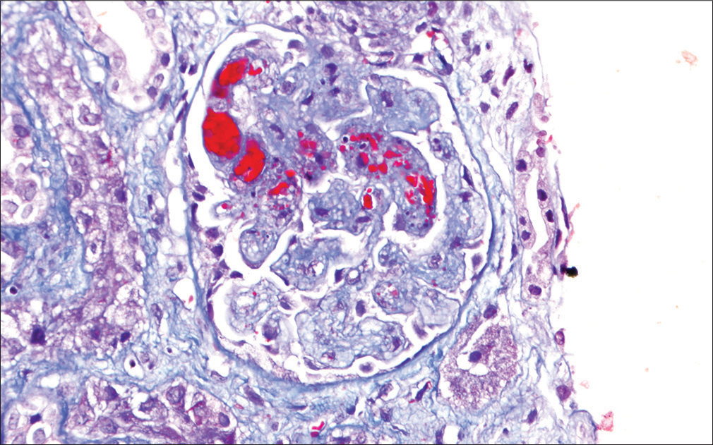 Light microscopy photo-micrograph showing glomerulus with mesangiolysis, intra-capillary fibrin thrombi, and the presence of fragmented RBCs in glomerular capillary lumina and mesangial areas (thrombotic micro-angiopathy) (Masson’s TrichromeX200).