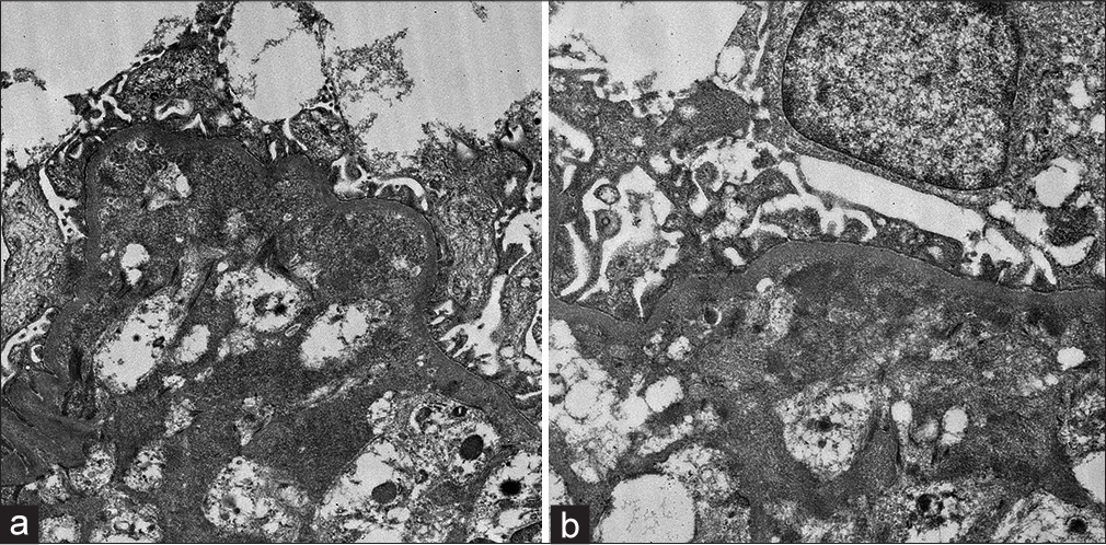 (a) Electron microscopy image showing loss of glomerular endothelial fenestrations and a marked expansion of the subendothelial area indicative of severe endothelial injury (EM X 2500) (b) Electron microscopy image showing paramesangial electron-dense deposits (EM X4000).