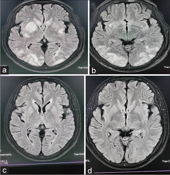 (a and b) MRI revealed multiple T2/FLAIR hyper-intensities of variable sizes in bilateral cerebral hemispheres, predominantly in the bilateral ganglio-capsular region (left > right) and bilateral occipital lobes, with minimal mass effect evident in the form of chinking of bilateral lateral ventricles adjacent to the lesions. (c and d) MRI revealed complete resolution of T2/FLAIR hyper-intensities in bilateral occipital regions and the left ganglio-capsular region with complete resolution of the mass effect. There was minimal residual hyper-intensity in the right ganglio-capsular region.