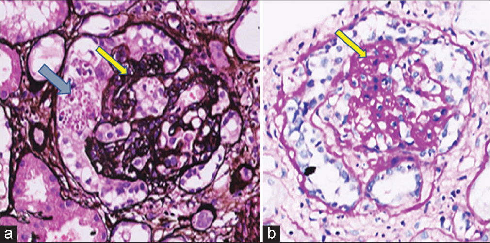 (a) Silver stain showing collapse of glomerular tuft (arrow), with the overlying visceral epithelial cell proliferation giving an appearance of a pseudocrescent (double arrow). (b) Hematoxylin and eosin stain showing segmental sclerosis (arrow) in the glomerular tuft.