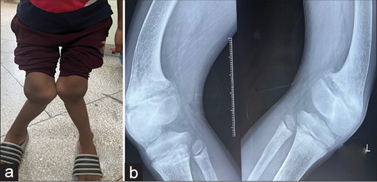 (a) Patient photograph showing bilateral knock knees (genu valgus) deformity. (b) X-ray anteroposterior at thigh showing bowing of both femur in inward direction at knee.