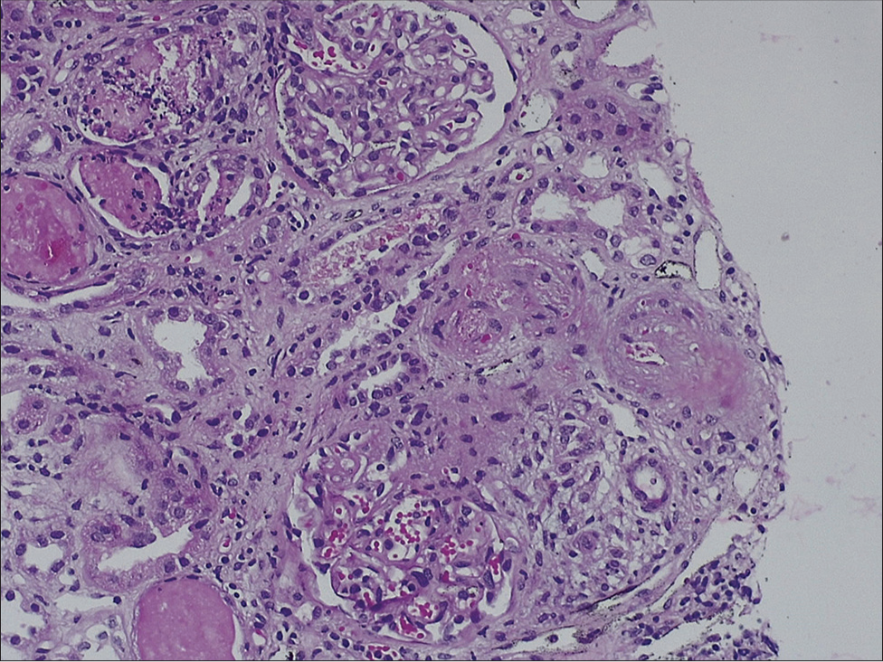 Light microscopy of the kidney biopsy specimen (hematoxylin and eosin stain) showing necrosis of arterial and arteriolar walls with RBC fragmentation and luminal thrombotic occlusion (TMA) with ischemic mesangiolysis of glomerular tufts. Stain for C4d was negative along peritubular capillaries (4.69 × 6.76 cm) RBC = red blood cell, TMA = thrombotic microangiopathy.