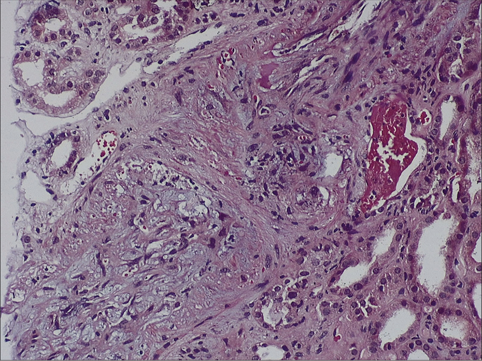 Light microscopy of the kidney biopsy specimen (hematoxylin and eosin stain) showing necrosis of arterial and arteriolar walls with RBC fragmentation and luminal thrombotic occlusion (TMA) with ischemic mesangiolysis of glomerular tufts. Stain for C4d was negative along peritubular capillaries (4.55 × 7.49 cm) RBC = red blood cell, TMA = thrombotic microangiopathy.