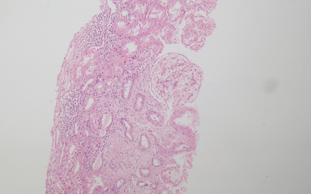 Photomicrograph of renal biopsy of a 39-year-old male showing focal global glomerular sclerosis, mildly enlarged viable glomerulus with no proliferative activity, and focal chronic interstitial nephritis (H and E ×100). H and E = hematoxylin and eosin.