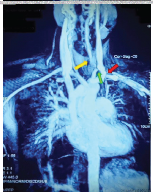 MR angiography of aorta and its branches shows wall thickening with enhancement of AoA, DTA, and upper AA with nearly complete occlusion of left common carotid artery (green arrow) and luminal narrowing of proximal subclavian (red arrow) and vertebral arteries (yellow arrow). AA = abdominal aorta, AoA = aortic arch, DTA = descending thoracic aorta, MR = magnetic resonance, NCCT: non contrast computerised tomographic scan.