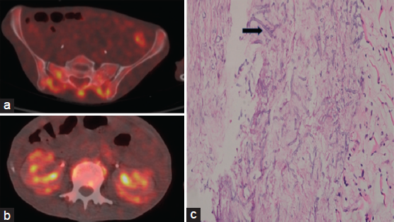 (a) FDG PET avid lytic skeletal lesions involving the sacrum, pelvic bones, and vertebrae. (b) Bilateral kidneys showing increasing FDG uptake in bilateral renal cortices with FDG-avid perinephric stranding. (c) Biopsy from sacral lesion showing extensive areas of necrosis with numerous broad foldable aseptate hyphae (black arrow) conforming to the morphology of Mucorales (hematoxylin and eosin stain, magnification 40×).