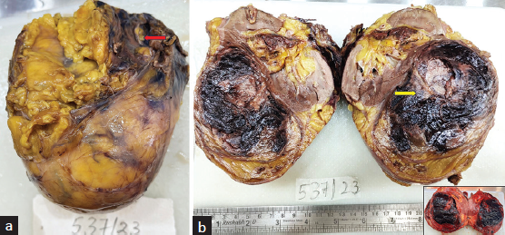 (a) Left nephrectomy specimen showing hematoma near the hilar region (red arrow); (b) Cut section showing grey-brown lesion with areas of hemorrhage and focal fat component (yellow arrow). Inset: Cut section – unfixed state.