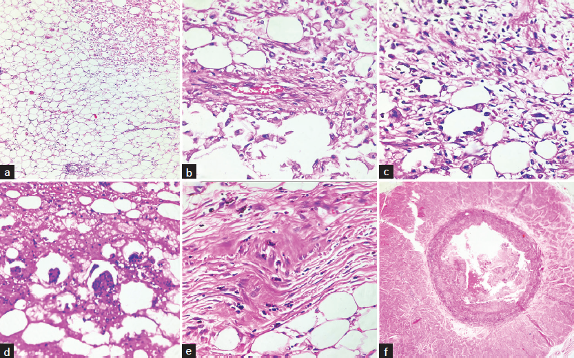 (a) Microphotograph showing sheets of mature adipose tissue with myoid component (right upper); (b) Dysmorphic blood vessels with thickened wall and perivascular epithelioid differentiation of myoid cells; (c) Myoid cells showing atypia with admixed fat cells; (d) Areas of fat necrosis with admixed inflammatory cells; (e) Fibrofatty areas showing pigment deposits; (f) Renal artery displaying thrombus formation.