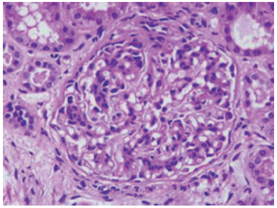 Membranoproliferative glomerulonephritis (periodic acid–Schiff stain, magnification ×400).