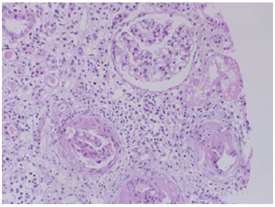 IgA nephropathy (hematoxylin and eosin stain, magnification ×100).