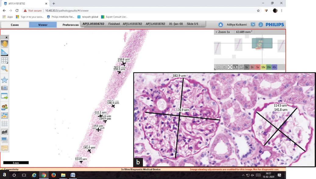 (a and b) Whole slide imaging of a Periodic Acid Schiff stained section and digitally annotated glomeruli (a: H&E stain 0.5x, b: 40x). H&E: hematoxylin and eosin.