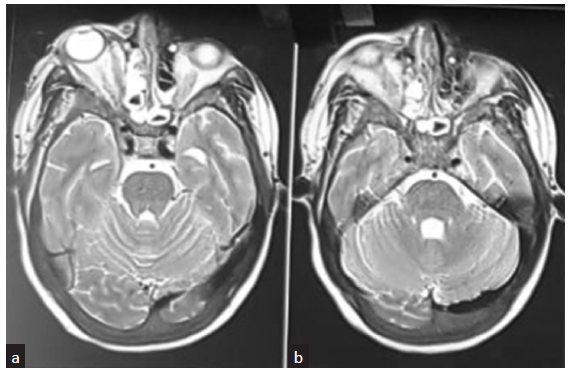 (a) MRI brain of patient 1 showing the periorbital edema, edema of ocular muscles and changes in paranasal sinuses. (b) MRI brain showing inflammation of paranasal sinuses. MRI: magnetic resonance imaging.