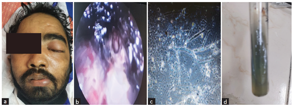 (a) Patient with abnormal swelling of left half of face. (b) FESS showing black necrotic tissue. (c) Calcofluor immunofluorescence showing fungal hyphae (d) Fungal growth on SDAe. FESS: functional endoscopic sinus surgery, SDA: sabarouds dextrose agar.