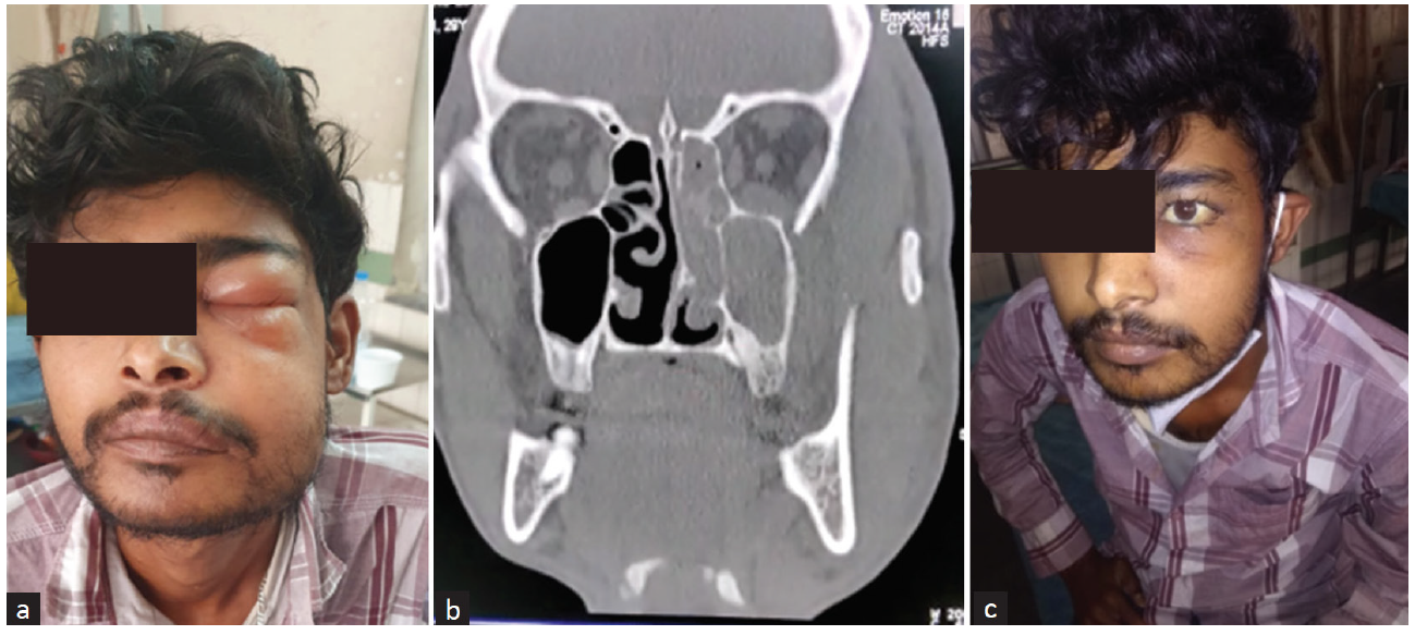 (a) Dialysis patient with swelling of face and jaw. (b) CT scan image showing maxillary ethmoidal sinusitis (c) Complete recovery after antifungal treatment.