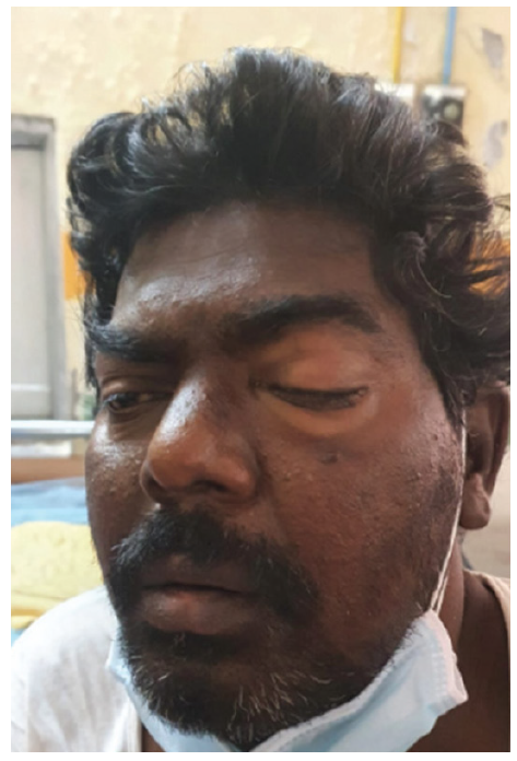 Dialysis patient with facial swelling, one week after COVID infection.