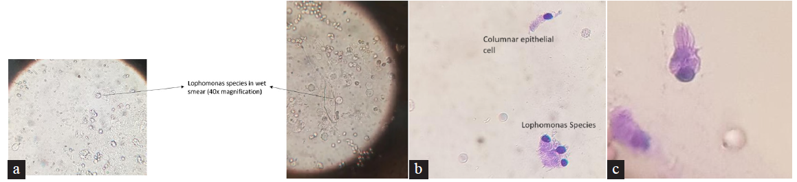 (a) Wet mount smear (40× magnification), (b) staining with methylene blue (40× magnification), (c) staining with Papanicolaou stain (100× magnification).