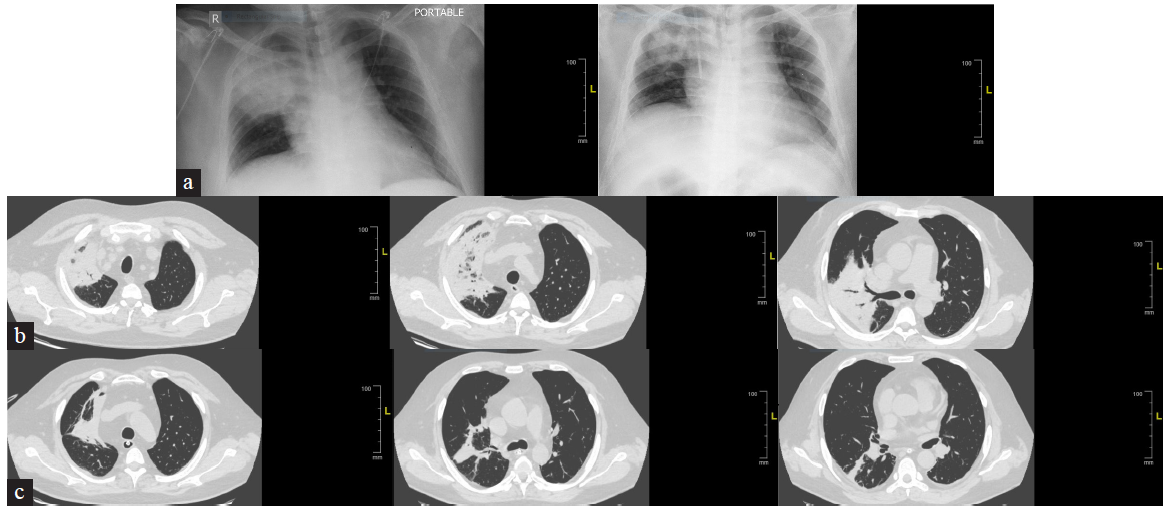 Images before and after treatment: (a) Chest X-ray before and after treatment. (b) CT images before treatment. (c) CT images after treatment. CT: computed tomography.