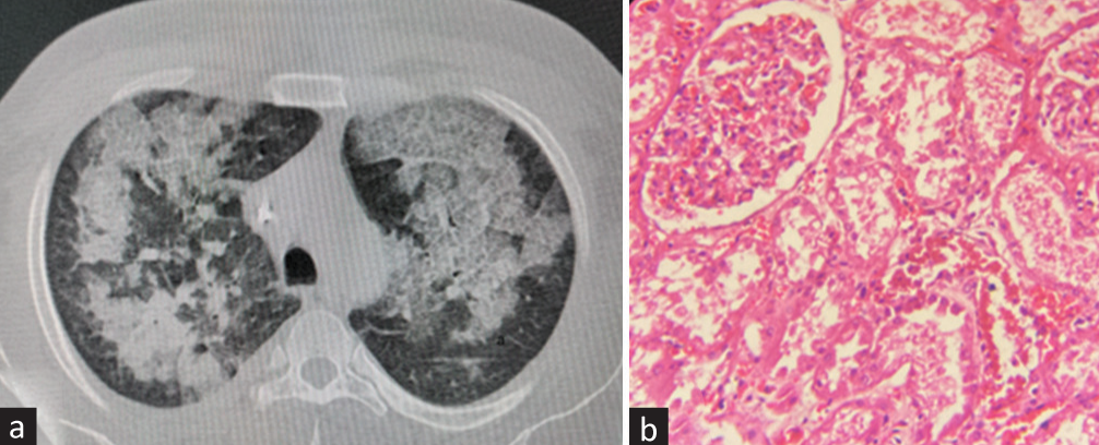 (a) NCCT chest lung window (axial section): multifocal areas of ground glass opacities with few areas of consolidation, consistent with acute interstitial pneumonia. (b) Renal biopsy (H and E, 400×). Normal glomerulus with tubules showing acute tubular necrosis. The interstitium is edematous with few inflammatory cells. H and E = hematoxylin and eosin, NCCT = noncontrast computerized tomography.