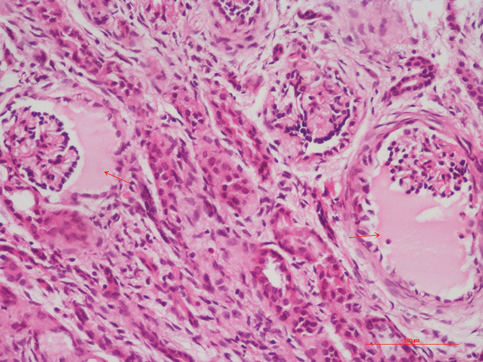 Renal biopsy depicting markedly dilated Bowman’s space (glomerular cysts) in two glomeruli (200×, Hematoxylin and Eosin).