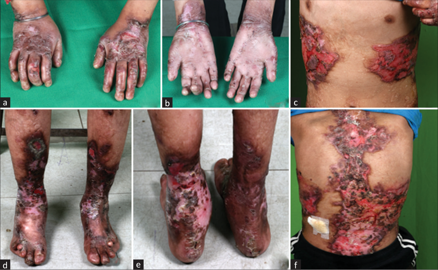 (a–f) Patient with severe generalized recessive dystrophic epidermolysis bullosa. (a and b) Erosions and scarring of the skin of palms and dorsa of both the hands with contracture of hands, pseudoainhum of distal phalanges, and anonychia. (c and f) Extensive areas of erosions and figurate scarring over the trunk. Note the discrete atrophic albopapuloid macules and papules over the back with a wrinkled surface. (d and e) Nonhealing ulcers over the legs with areas of depigmentation and scarring accompanying nail loss and deformity of toes.