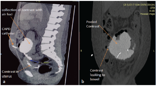 Computer tomographic images after injecting contrast from CAPD catheter (a) showing encapsulated collection with air foci in peritoneum with fistulous communication of peritoneal dialysis catheter with uterine cavity (through a fundal rent) (orange arrows) (b) fistulous tract communicating with small bowel (orange arrows).