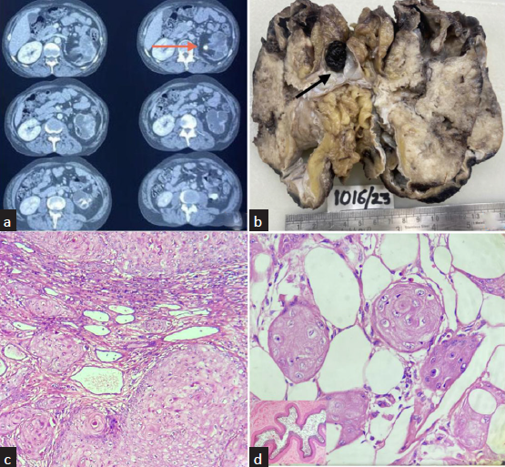 (a) Serial slice of computed tomogrpahy showing left kidney (orange arrow) showing a hydronephrotic kidney with cortical thinning and stone at pelvi-ureteric junction. (b) Cut section of nephrectomy specimen showing loss of corticomedullary differentiation with dilated calyces and an impacted stone (black arrow) at pelviuretric junction. (c) Microphotograph showing moderately differentiated squamous cell carcinoma invading atrophic tubules (H&E ×40). (d) Squamous cell carcinoma infiltrating the perinephric fat. (H&E 40×) Inset-Ureter with lumen displaying complete squamous metaplasia of the lining epithelium. (H&E ×10).