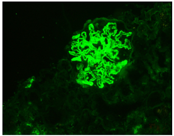 IgG immunofluorescence positive in the glomeruli (intensity-3+), IgG: Immunoglobulin G.