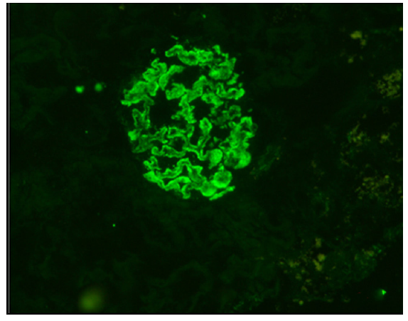 C1q immunofluorescence positive in the glomeruli (intensity-2+).