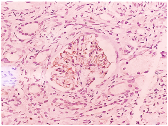 NELL-1 immunohistochemistry positive in the glomeruli (intensity-3+), NELL-1: Nerve epidermal growth factor like protein.