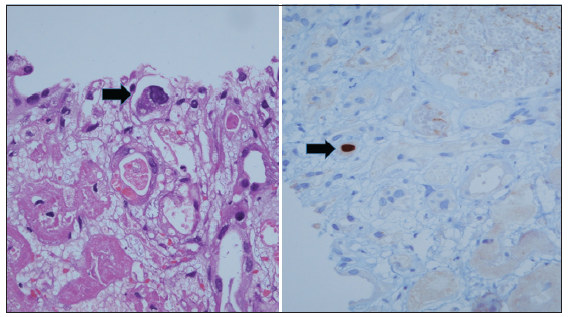 Renal biopsy shows patchy cortical infarction with occasional large endothelial cells (black arrow) with ground glass nuclei (original magnification ×400; Hematoxylin and Eosin). HSV2 immunohistochemistry shows nuclear positivity (black arrow) in the enlarged endothelial cell (original magnification ×400; HSV2 immunohistochemistry).