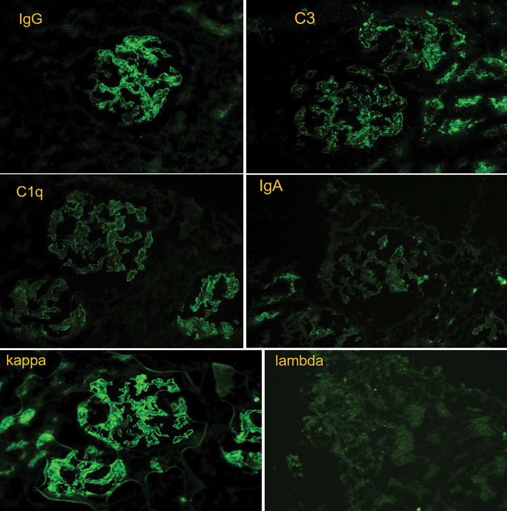 Immunofluorescence microscopy showing glomerular deposits stained with anti-Immunoglobulin and anti-kappa (light chain) antibodies. Anti-lamba staining is notably absent (x400).