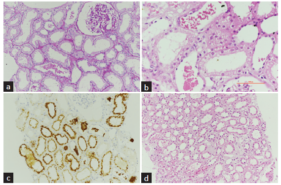 Light microscopic and immunofluorescence findings of kidney biopsy. (a) 20x, PAS: Renal cortex showing normal glomerulus. Few tubules contain atypical globular casts with associated acute tubular injury. (b) 40x, H and E: Tubules containing atypical red globular casts with attenuation of the proximal tubular epithelial cells, cytoplasmic vacuolization, and variable loss of the brush borders. (c) 20x: The atypical intratubular casts and some of the tubular epithelial cells stain positively for myoglobin immunohistochemistry. (d) 20x, H and E: Mild edema and interstitial inflammation.