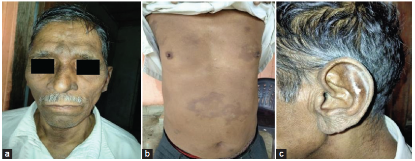 Clinical presentation: (a) coarse facial features, madarosis, and hyperpigmented patches; (b) hypo- and hyperpigmented patches over the torso; and (c) patches over the earlobe.