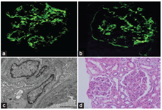 Renal biopsy: (a) immunofluorescence showing granular mesangial and endocapillary C3 deposits; (b) immunofluorescence showing granular endocapillary and mesangial IgG deposits; (c) electron microscopy; and (d) light microscopy.