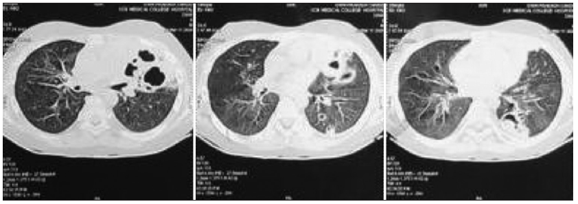 High-resolution computed tomography (HRCT) of lungs revealing multicystic lesions with surrounding consolidation and air bronchogram.