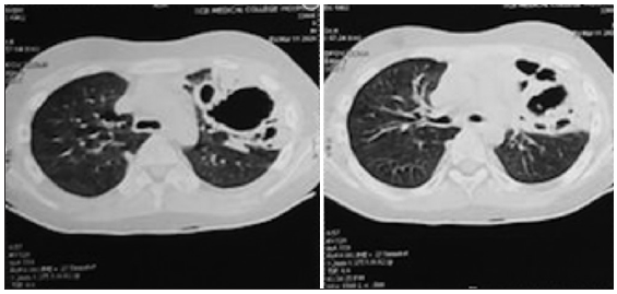 High resolution computed tomography (HRCT) shows bilateral ground glass appearance.