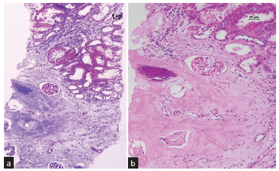 (a) Woven bone is seen in the renal parenchyma. The surrounding tissue shows fibrosis of the interstitium (Masson trichrome stain, 100×). (b) There is a focus of mineralization within the woven bone (hematoxylin and eosin stain, 200×).