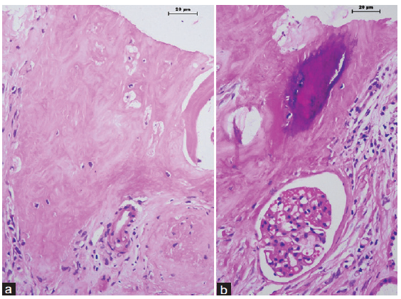 There are (a) osteocytes within lacunae and (b) a focus of mineralization (hematoxylin and eosin stain, 400×).