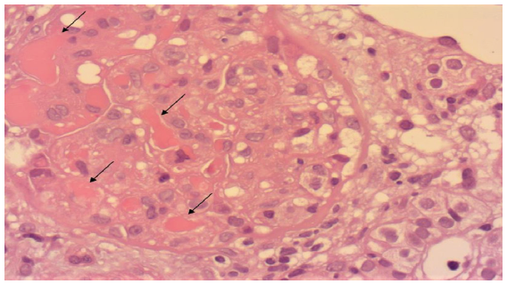 Cryoglobulinemic glomerulonephritis with membrano-proliferative pattern: A glomerulus showing mesangial hypercellularity and cryoglobulin plugs within capillary loops (black arrows) (H&E stain, original magnification ×400).