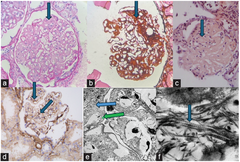 (a) PAS negative widened mesangium (400x, blue arrow), (b) Silver negative widened mesangium, (400x, blue arrow). (c) Congo red negative widened mesangium (400x, blue arrow), (d) Type III collagen IHC, blue arrows marking peripheral and mesangial location of IHC stain. (e) Electronmicroscopy, blue arrow pointing mesangial location, green arrow pointing subendothelial location of fibrils. Original magnification 600x. (f) Electronmicroscopy, Curvilinear banded fibrils, 29.15 nm, original magnification 10000x, blue arrow.