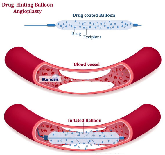 The schematic diagram of drug-eluting balloon angioplasty.