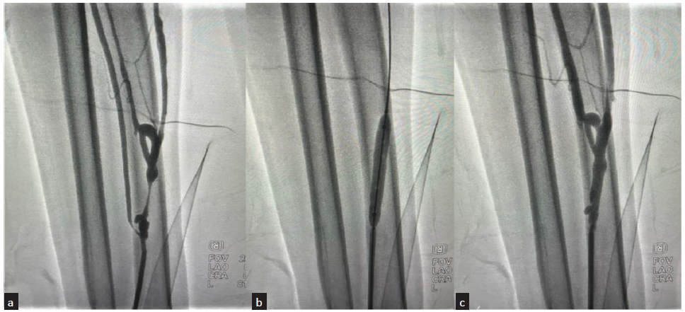 Angiographic images of percutaneous balloon angioplasty performed for radio-cephalic fistula with stenosis in 53-year-male patient. (a) Fistulogram from retrograde radial access showing short segment stenosis of the draining cephalic vein just distal to fistula; (b) Percutaneous angioplasty performed by inflating the balloon across the stenosis; (c) Post angioplasty, angiography showing no residual stenosis with good flow into the cephalic vein.