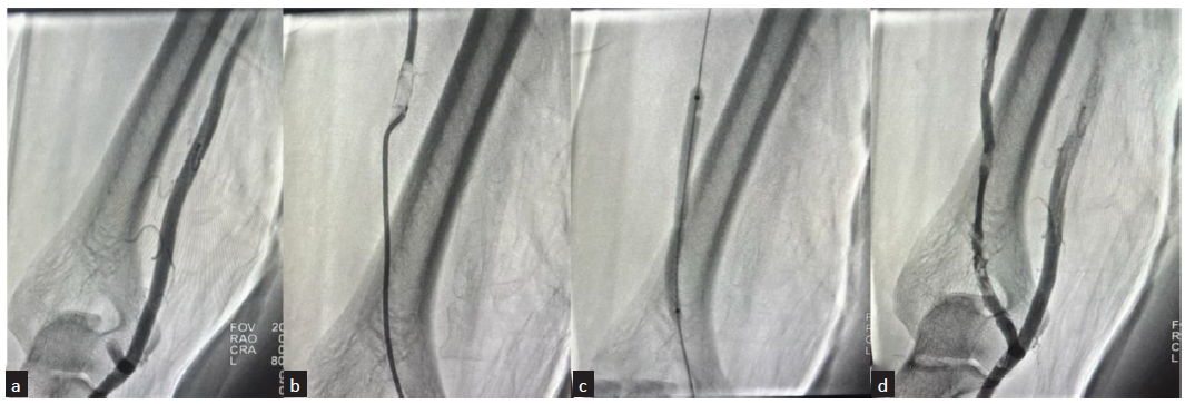 Angiographic images of percutaneous balloon angioplasty performed for thrombosed brachio-cephalic fistula in 64-year-male patient. (a) Fistulogram from retrograde radial access showing cut-off beyond short stump of cephalic vein at elbow; (b) Catheter negotiated through the thrombotic segment and angiogram showing filling defect in upper cephalic vein suggestive of thrombus; (c) Percutaneous angioplasty performed by inflating the balloon across the thrombotic segment; (d) Post angioplasty, angiography showing good flow across the fistula into the cephalic vein, with no demonstrable filling defects.