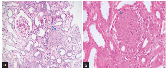 (a) Section from renal cortex shows circumscribed non-necrotizing granuloma comprising epithelioid histiocytes and lymphocytes (blue arrow). PAS stain ×200 original magnification. (b) Section from the renal cortex shows circumscribed non-necrotizing granuloma composed of epithelioid histiocytes and lymphocytes (blue arrow) in another patient. H&E stain ×400 original magnification.