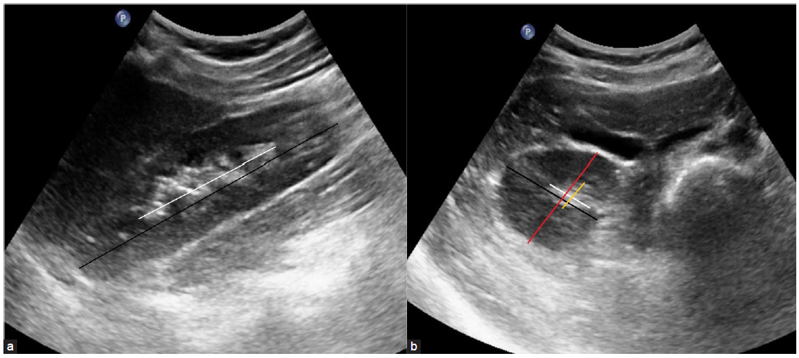 (a) Measurement of renal length (black line) and central echogenic area (white line) in the longitudinal section of the kidney. (b) Width (black line) and thickness (red line) of the kidney and central echogenic area (white and yellow line, respectively) in the axial section of the kidney.