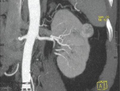 CT urography revealing exophytic hypodense lesion of size 22 × 21 × 22 mm arising from the lateral cortex at the upper pole of the left kidney, showing heterogenous arterial enhancement. CT = computed tomography