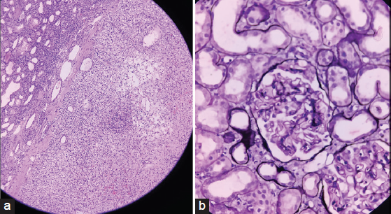 (a) Tumor reveals typical patterns including nests with delicate interconnecting vessels. The cytoplasm of tumor cells is clear and eosinophilic (H and E stain, 10×). (b) Light microscopy-Diffuse uniform basement membrane thickening with variable mesangial matrix expansion in the nontumorous portion (methenamine silver stain, 100×). H and E = hematoxylin and eosin