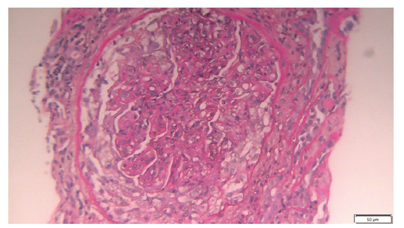 Circumferential cell crescent in a glomerulus with global endocapillary proliferation, lobulation, and double contours (light microscopy 20x).