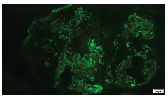 Granular deposits of C3 in the mesangium and capillary (immunofluorescence).